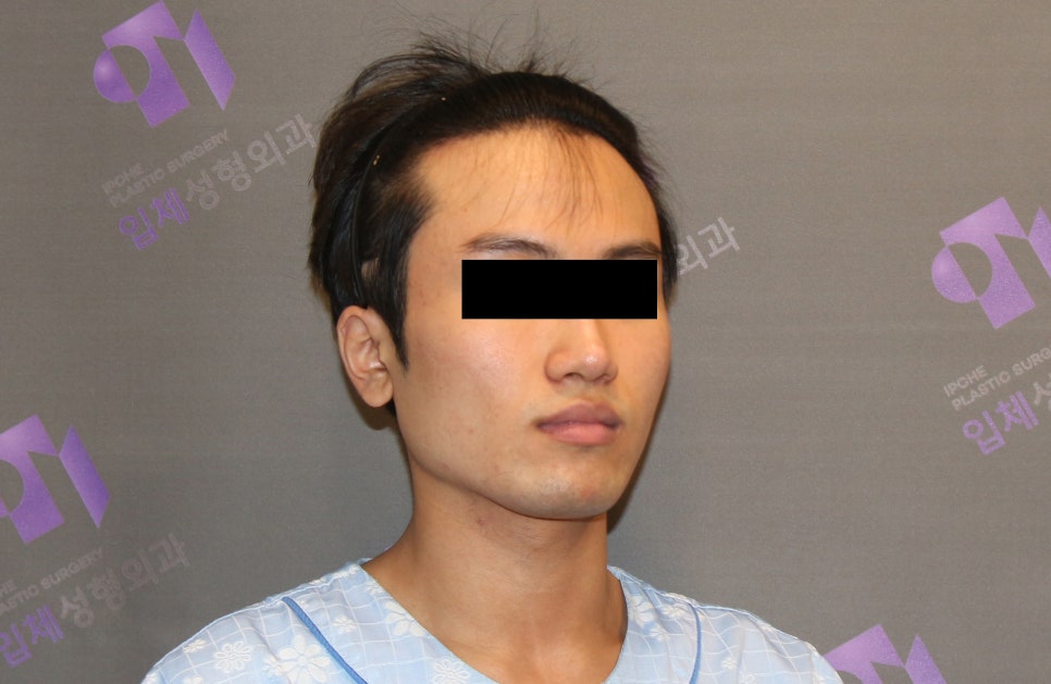 남자사각턱, 남자다운 턱선이 중요한 안면윤곽수술 관련 이미지 2