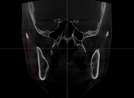 What Are Contouring 3, 4, and 5 Procedures, and Which Surgery Should I Have? image 6