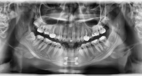 Is There a Way to Address the Secondary Angle That Appears After Chin Surgery? image 7