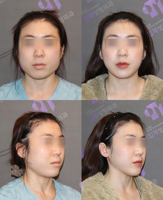 Are There People Who Can’t Have Cortical Ostectomy Surgery for a Frontal Square Jaw Effect? image 15