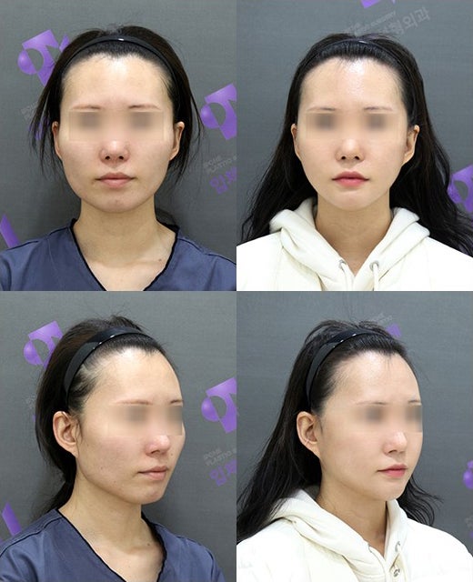 Square Jaw Surgery: The Difference Between Cortical Osteotomy and Lateral Cortical Shaving image 12