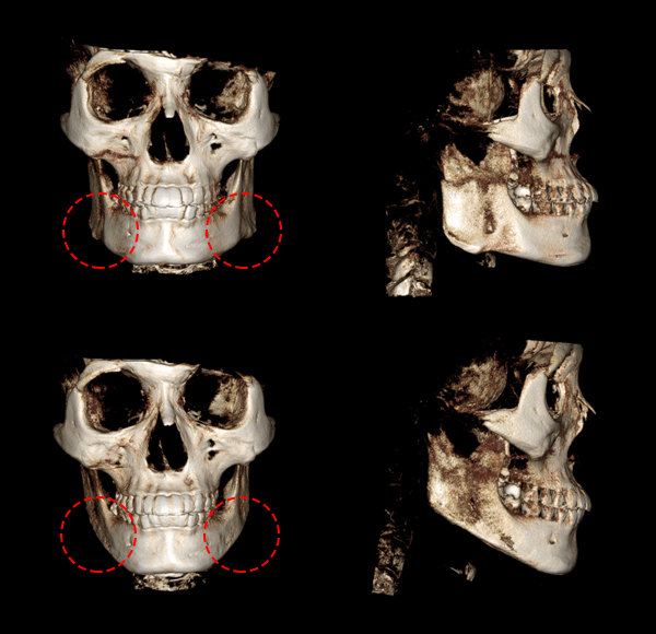 V-Line Square Jaw Surgery Is Good for the Front View Effect image 12