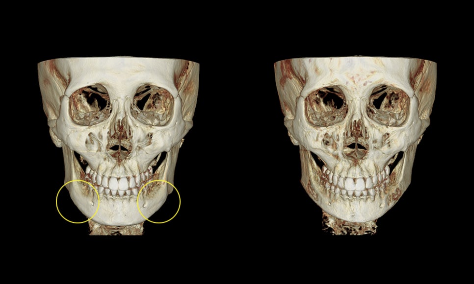 Square Jaw Surgery: The Difference Between Cortical Osteotomy and Lateral Cortical Shaving image 6
