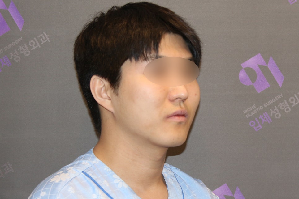 Male Cheekbone Reduction Surgery: Looking at Real Cases of Facial Contouring Surgery image 2