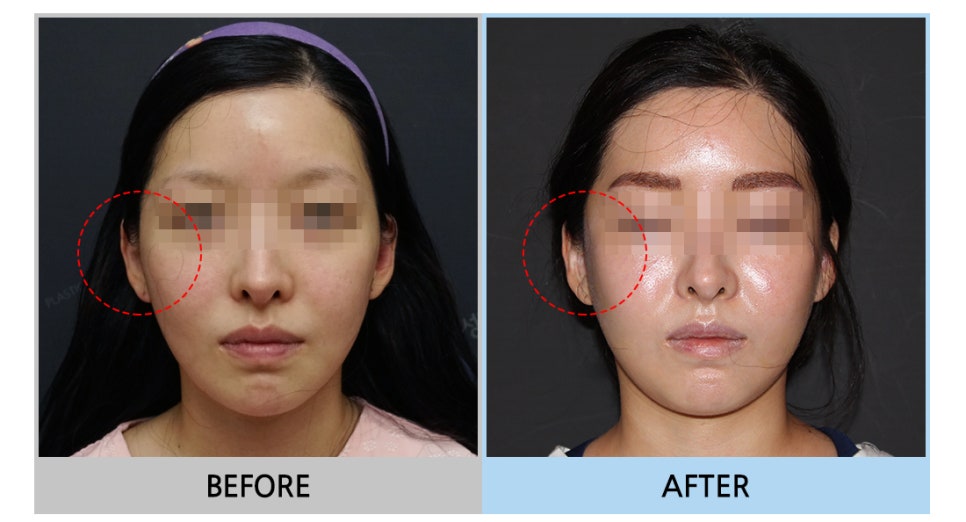Considering revision cheekbone surgery, is it possible with a 230-degree three-dimensional cheekbone reduction as well? image 3