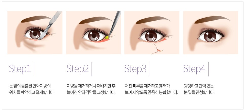 눈밑지방재배치와 하안검 수술이 어떻게 다른가요? 관련 이미지 14