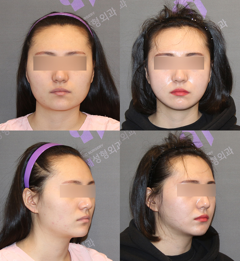 Is General Anesthesia Absolutely Necessary for Cheekbone Surgery in Facial Contouring? - Explained by a Board-Certified Plastic Surgeon image 2