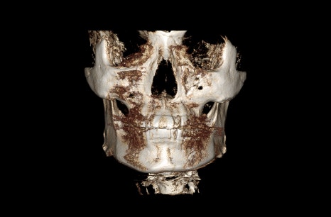 Are There People Who Can’t Have Cortical Ostectomy Surgery for a Frontal Square Jaw Effect? image 10