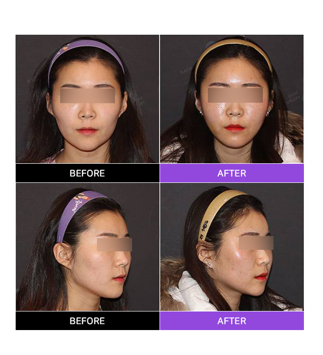 Sunken Cheeks!? It’s Not a Side Effect of Zygoma Surgery! image 4