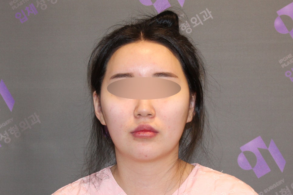 Why Cheekbones Show When You Smile, and Why Cheekbone Surgery May Not Help - Explained by a Specialist image 1