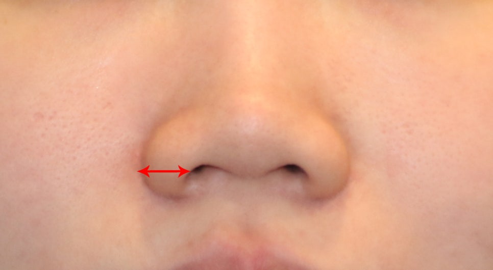 Incisional or Non-incisional? A Review of Alar Reduction Surgery Cases (Alar Base Reduction) image 2