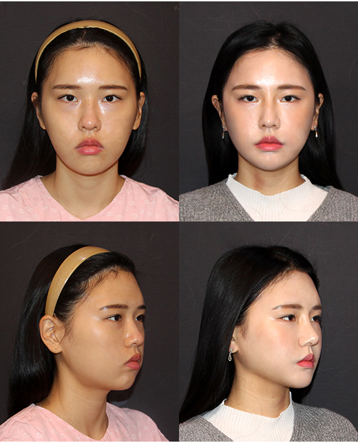 안면윤곽 수술과 같이 하면 좋은 수술 관련 이미지 3