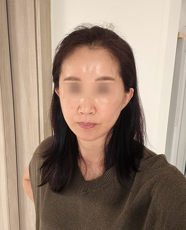 Facelift Recovery Period: When Will My Face Look Natural Again? image 7