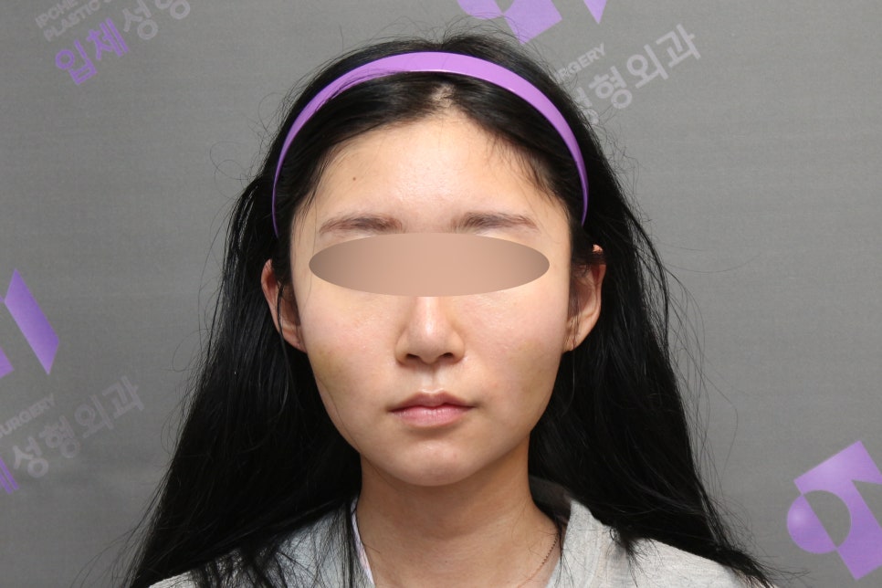45-Degree Cheekbone Reduction Surgery Review, Let’s Look at Cases Together - Information from a Specialist image 3