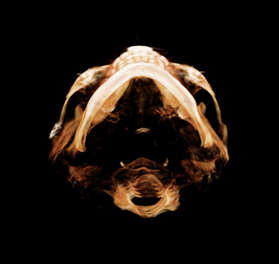 45도광대, 옆광대수술 후 광대재수술은 얼마나 효과가 있을까요? 관련 이미지 10