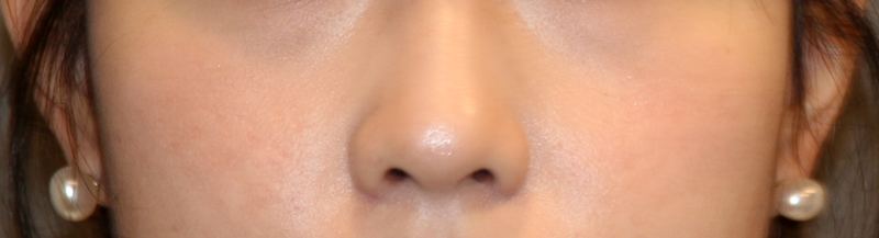 Is There a Nose Alar Reduction Surgery Without Scarring? (Looking at Before-and-After Photos) image 7
