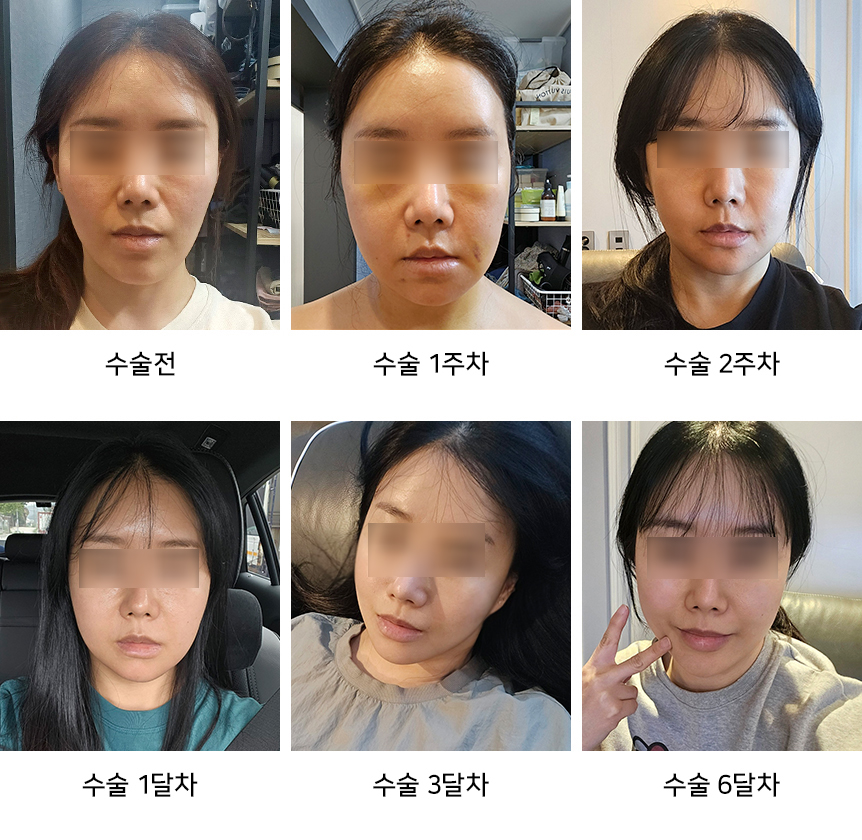Facial Contouring A to Z: What Is Contouring Surgery? image 16