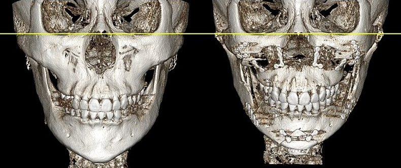 Which Surgery Do I Need: Contouring Surgery or Double-Jaw Surgery? image 17