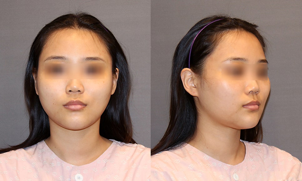 Does the Surgical Method Change Depending on the Protruding Cheekbone Location? Exact Locations and Diagnosis of the Front Cheekbone, Side Cheekbone, 45-Degree Cheekbone, and Back Cheekbone image 4