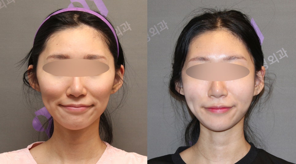 45-Degree Cheekbone Reduction Surgery Review, Let’s Look at Cases Together - Information from a Specialist image 7
