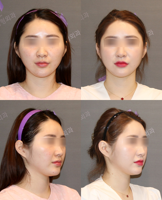 Will Zygoma Reduction Surgery Make Your Face Look Longer? - Explained by a Board-Certified Plastic Surgeon image 4
