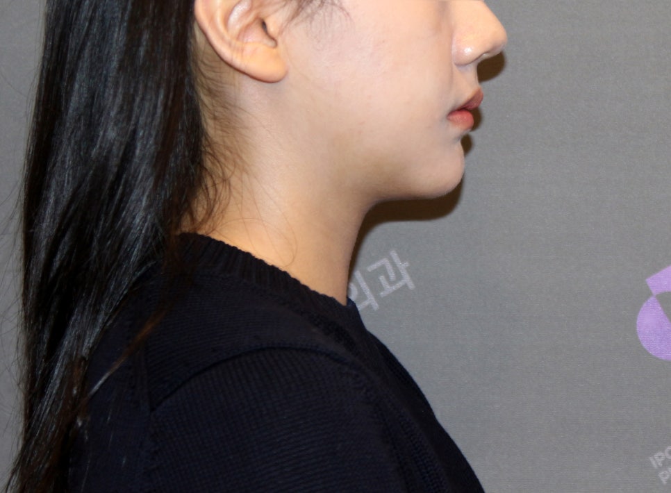 짧고 심한 무턱은 턱끝전진술로 개선이 가능할까요? 관련 이미지 8