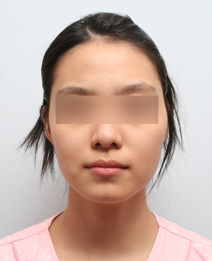If the Face (Cheekbones) Is Asymmetrical, Can It Be Corrected with Cheekbone Reduction Surgery? image 2