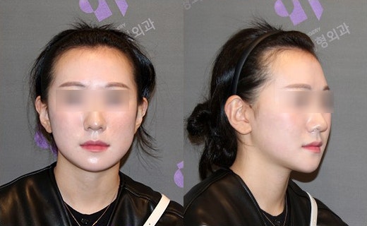 긴턱 교정은 어떤 수술이 좋을까요? 턱끝축소술의 한계와 실제 결과 관련 이미지 8