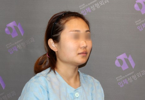 Square Jaw Surgery: What Are a Retracted Jaw and a Protruding Jaw? image 2