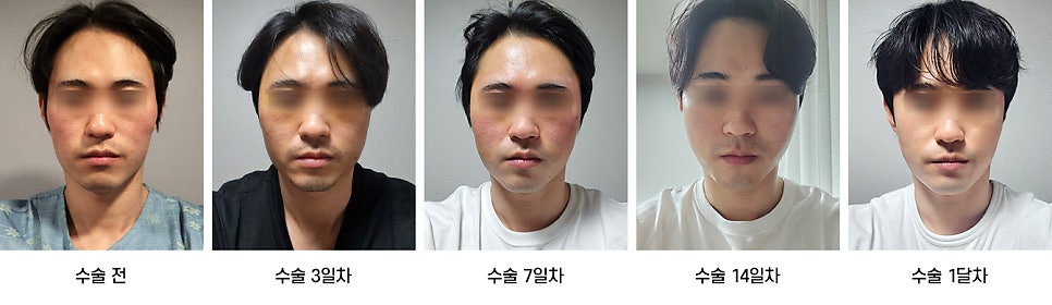 안면윤곽 수술 후 붓기, 일상생활은 언제부터 가능한가요? 케이스별로 알아보기 관련 이미지 6