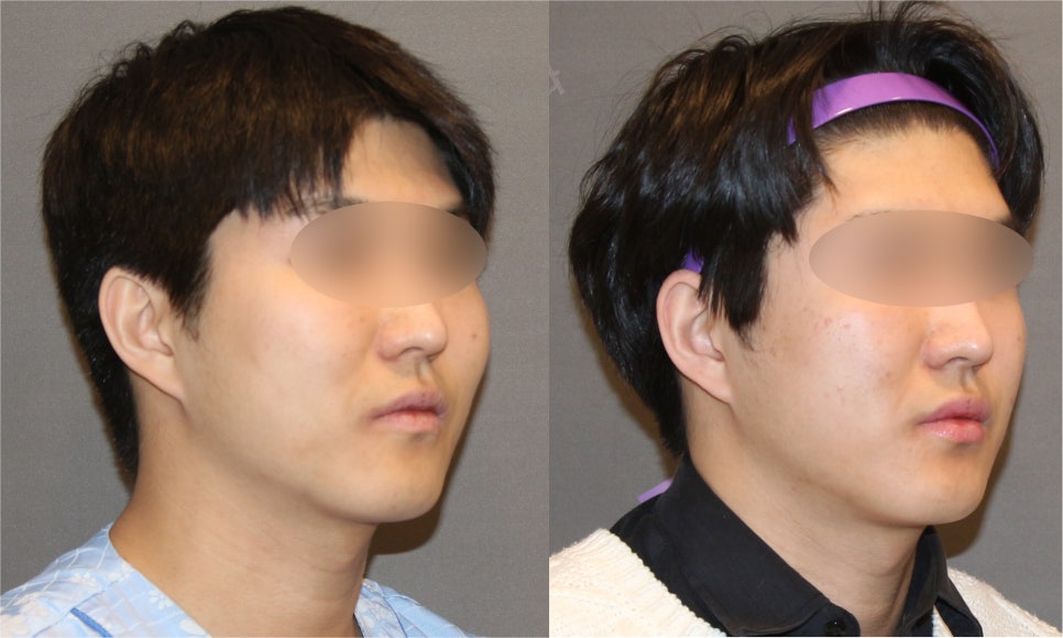 Male Cheekbone Reduction Surgery: Looking at Real Cases of Facial Contouring Surgery image 6