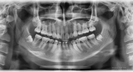 Which Surgery Do I Need: Contouring Surgery or Double-Jaw Surgery? image 14