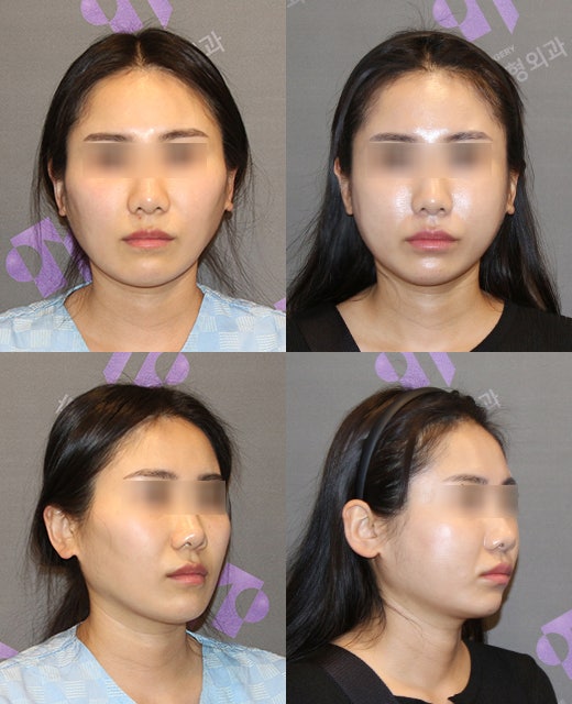 The Story After Cheek Dimple Correction image 5