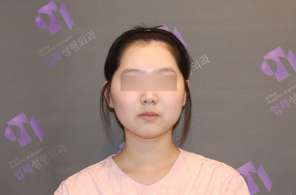If the Face (Cheekbones) Is Asymmetrical, Can It Be Corrected with Cheekbone Reduction Surgery? image 6