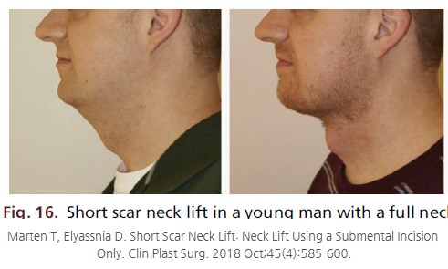 3 Face Types That Benefit from Submental Lift Surgery image 3