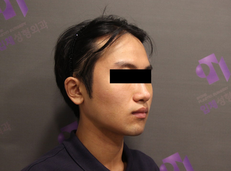 남자사각턱, 남자다운 턱선이 중요한 안면윤곽수술 관련 이미지 5