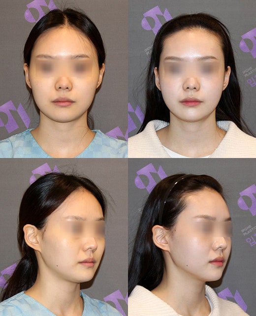 광대뼈 쉐이빙(갈아내기)을 하면 정말 볼처짐이 올까요? 관련 이미지 2