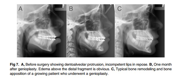 [Paper Review] The Relationship Between Forward Movement of the Chin Bone and Soft Tissue Movement: After Chin Advancement Surgery, How Will My Face Actually Change? image 12