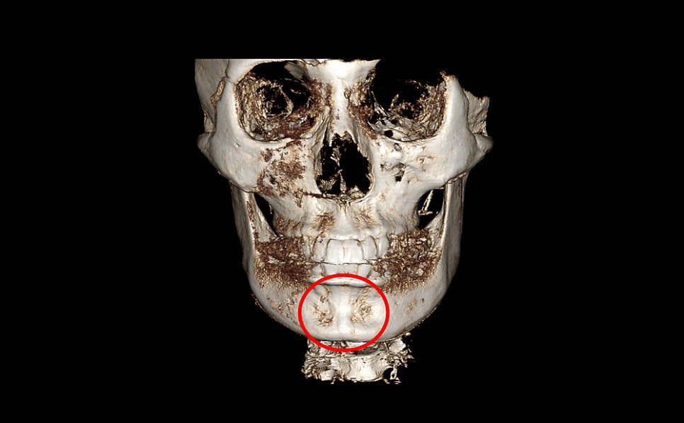 Does chin filler or an implant cause bone erosion? image 7