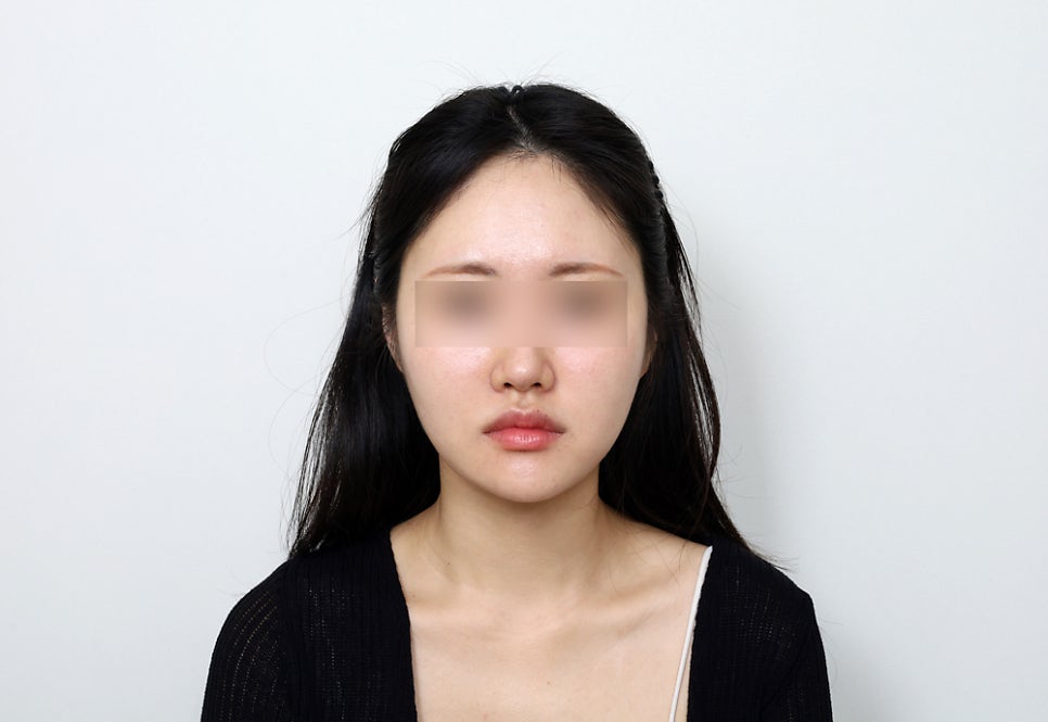 Square Jaw Surgery: The Difference Between Cortical Osteotomy and Lateral Cortical Shaving image 11