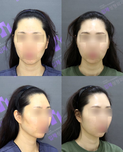How effective is the incision method compared to the non-incision method for cheek hollow correction? image 5
