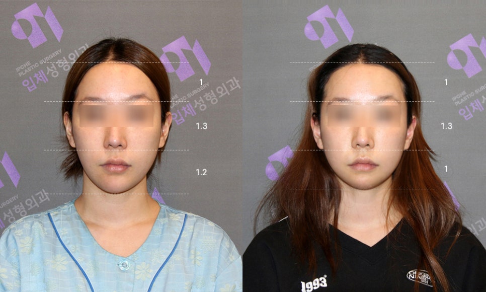 긴턱수술 후 중안면부 얼굴이 길어 보일까요? 관련 이미지 6