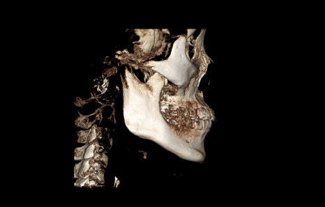 Square Jaw Surgery: What Are a Retracted Jaw and a Protruding Jaw? image 9