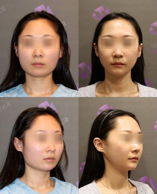 안면윤곽수술 후 붓기, 일차별(1일~30일차) 사진과 함께 회복기간 알아보기 관련 이미지 5