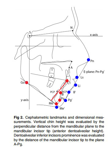 [Paper Review] The Relationship Between Forward Movement of the Chin Bone and Soft Tissue Movement: After Chin Advancement Surgery, How Will My Face Actually Change? image 4