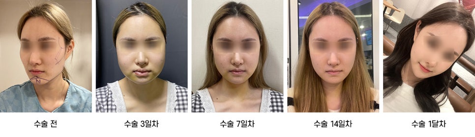 안면윤곽 수술 후 붓기, 일상생활은 언제부터 가능한가요? 케이스별로 알아보기 관련 이미지 8