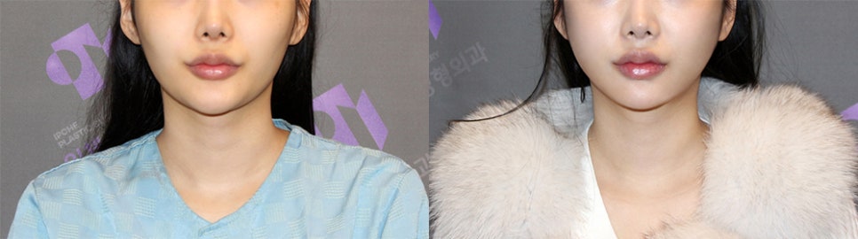 How Should Witch Chin Be Treated When You Smile? image 2