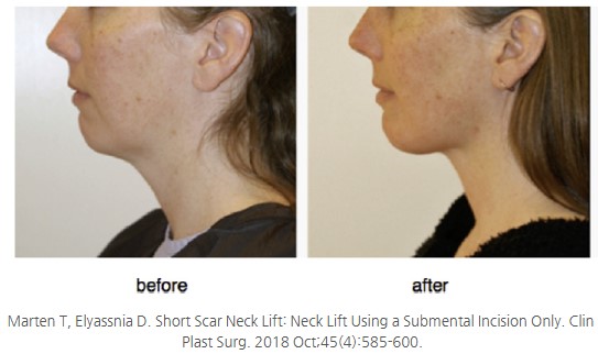 3 Face Types That Benefit from Submental Lift Surgery image 1