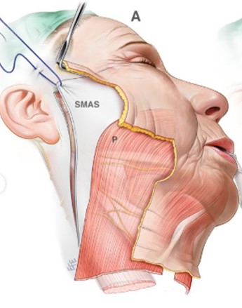 Q&A on Facelift Surgery (2): How Liposuction and AccuSculpt Affect the SMAS image 3