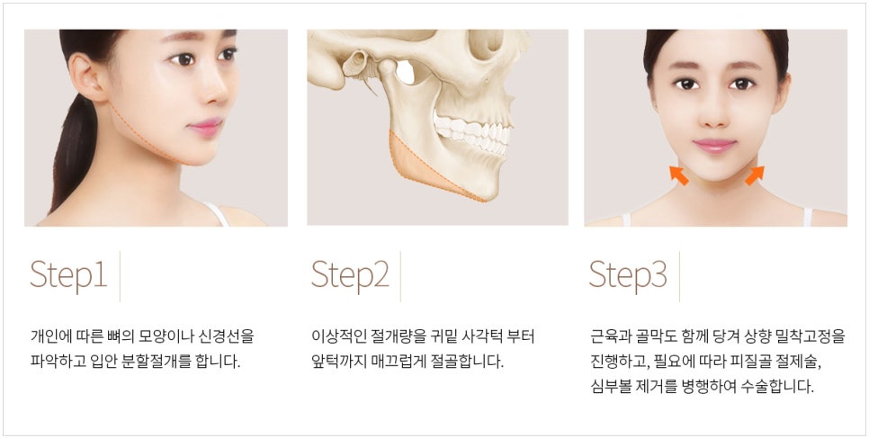 사각턱교정, 긴곡선 사각턱수술과 귀뒤사각턱의 차이와 CT분석 관련 이미지 7
